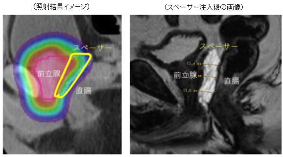 陽子線治療はどのように行われるのですか?