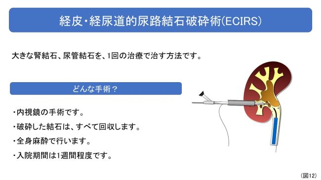 経皮・経尿道的尿路結石砕石術（ECIRS）