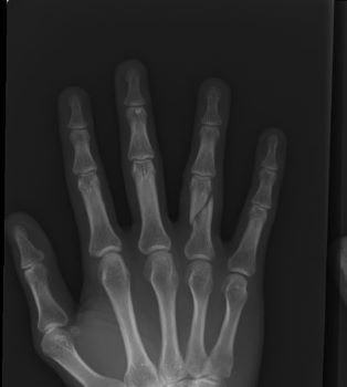 右環指基節骨骨折