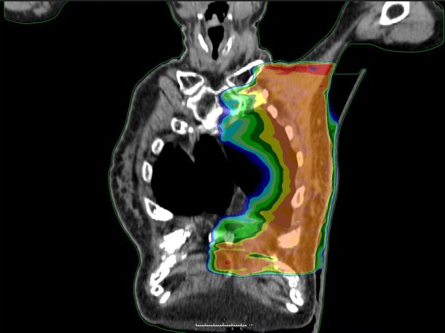 乳癌に対して鎖骨上窩と胸壁に対してVMATで放射線治療した症例。